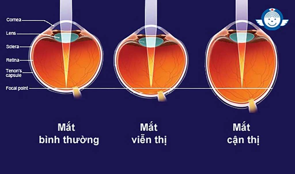 Hình ảnh về tật khúc xạ